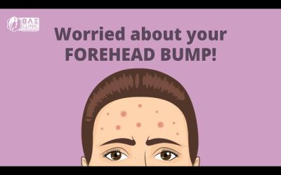 Worried about your forehead bumps?