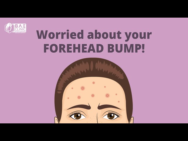 Worried about your forehead bumps?