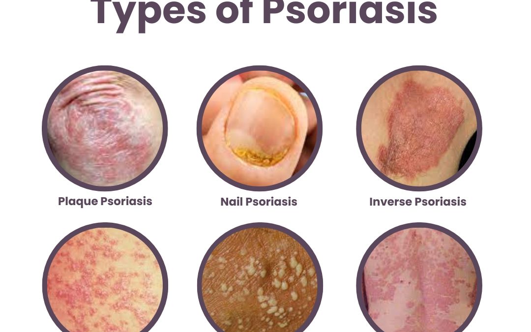 Types of Psoriasis