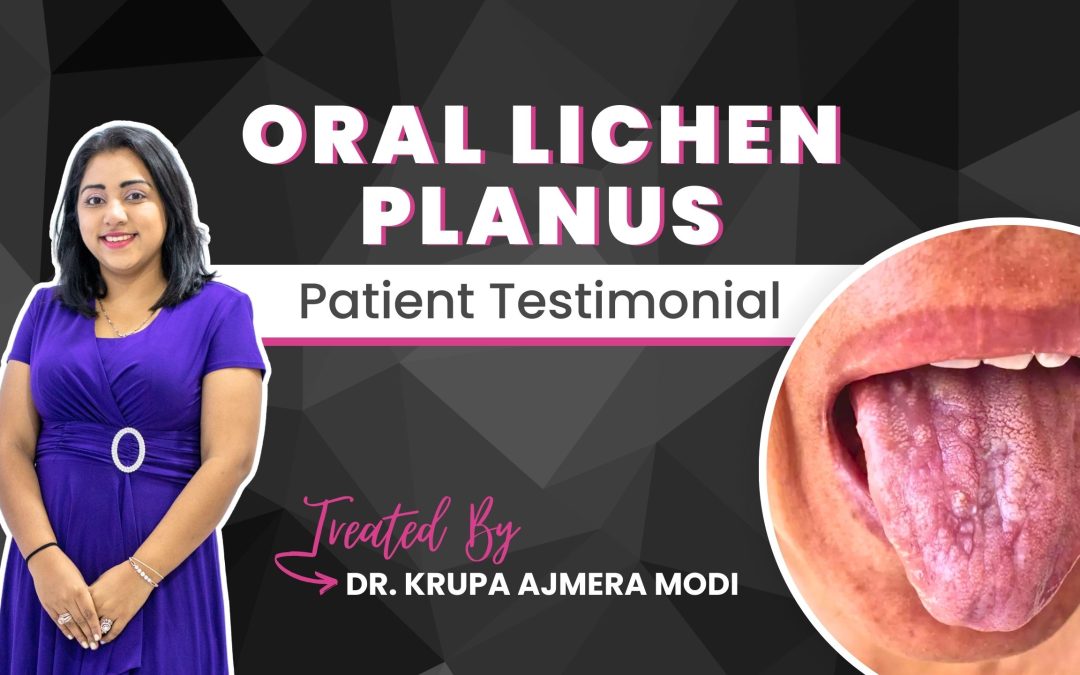 Patient testimonial | Oral Lichen Planus | Treated by Dr. Krupa Ajmera Modi