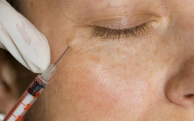 Dermal Filler