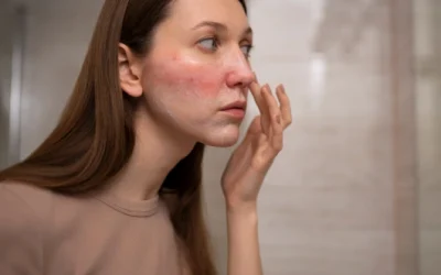 Rosacea Treatment