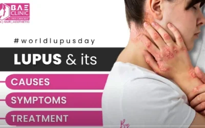 Systemic Lupus Erythematosus (SLE): Causes, Symptoms, Diagnosis | Dr. Krupa Ajmera Modi
