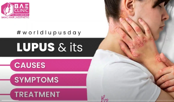 Systemic Lupus Erythematosus (SLE): Causes, Symptoms, Diagnosis | Dr. Krupa Ajmera Modi