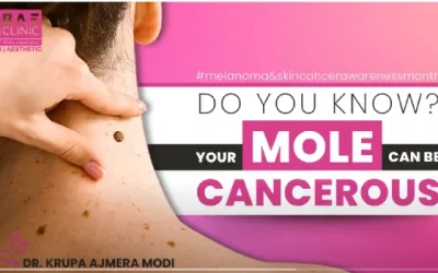 Understanding Melanoma: Causes, Symptoms, and Treatments | Skin Cancer Awareness Month