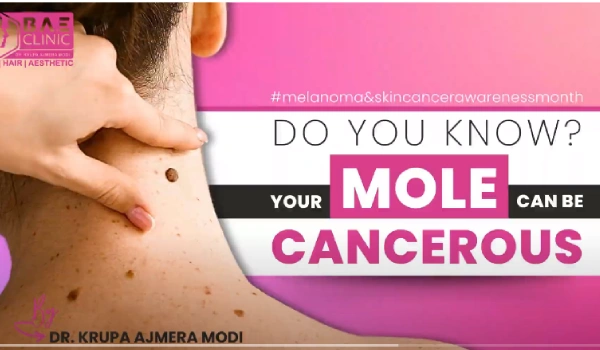 Understanding Melanoma: Causes, Symptoms, and Treatments | Skin Cancer Awareness Month