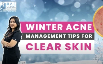 Winter Acne Management Tips: Adjust Your Skincare Routine for Radiant Skin in the Cold Season!
