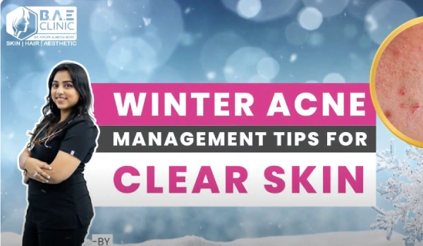 Winter Acne Management Tips: Adjust Your Skincare Routine for Radiant Skin in the Cold Season!