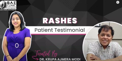 Rapid Relief from Rash Infections | Dr. Krupa Modi’s Expertise